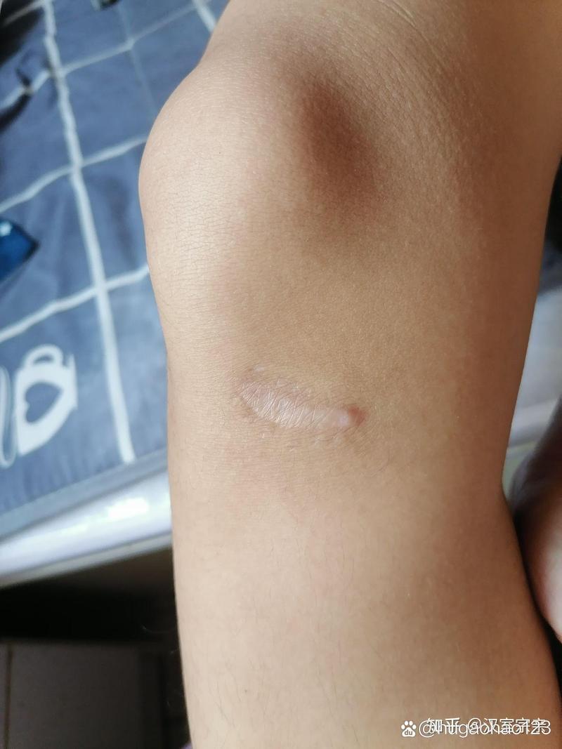 疤痕影响国考报名吗？-图1