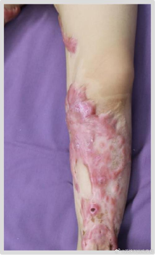 疤痕影响国考报名吗？-图3