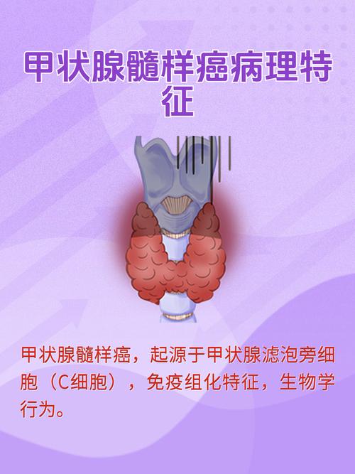 甲状腺癌国考是什么?为何要考?-图1 甲状腺癌国考是什么?为何要考?-图1